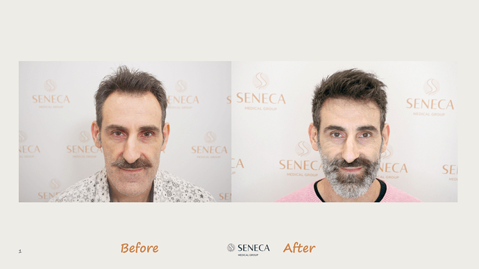 Seneca Medical Group - 1500 grafts with Direct Fue photo