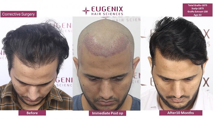 Corrective Hair Transplantation | Hairline Correction I 7 months update @Eugenix Hair Sciences photo