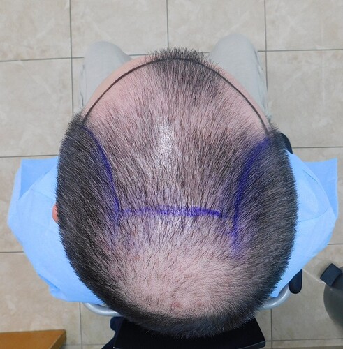 FUE Result for 4400 Grafts – 6 Months after – HDC Hair Clinic photo