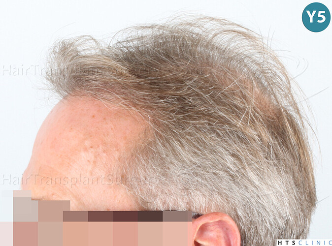 Dr Devroye + Dr Montesanti + Dr Jenard / 7015 grafts (4512 FUT + 2503 FUE) / 2 sessions photo