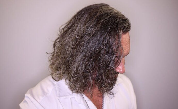 Utah Hair Restoration - Dr. Barton alviarmani photo