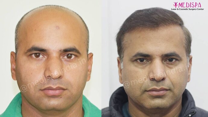 11600 Grafts in 3 FUT Sittings by Dr Suneet Soni photo