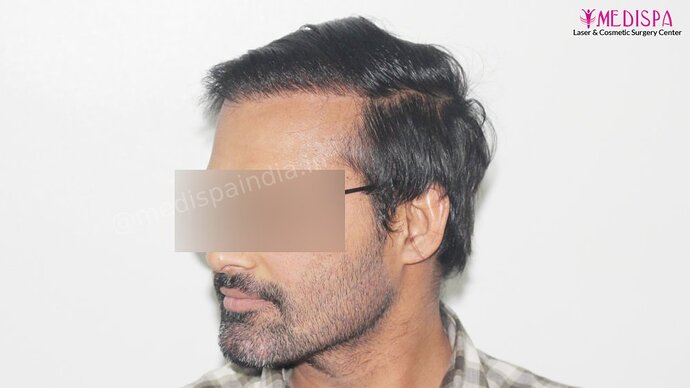 Revision Hair Transplant - 5111 Grafts / 5 Years Result - Dr. Suneet Soni, Medispa India photo