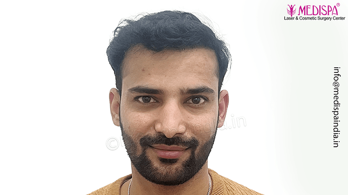 Dr. Suneet Soni - 4046 Grafts | 12-Month Result | Combination FUT + FUE + Beard photo