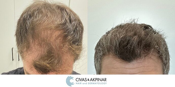 Civas&Akpınar Hair Transplant- FUE Hair Transplant Before & After Pictures (3200 Grafts) photo