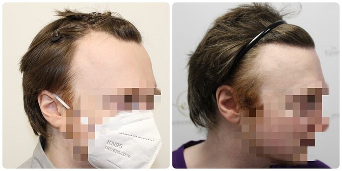 Dr Bonaros, Glasgow, UK / 1614 FUE grafts for receding Hairline / 0-12 Months photo