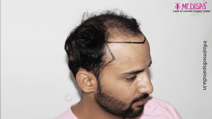 Dr. Suneet Soni - 4046 Grafts | 12-Month Result | Combination FUT + FUE + Beard photo