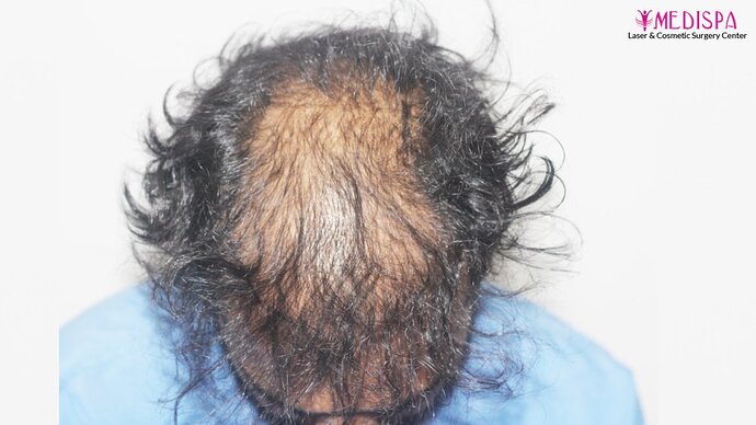 Revision Hair Transplant - 5111 Grafts / 5 Years Result - Dr. Suneet Soni, Medispa India photo