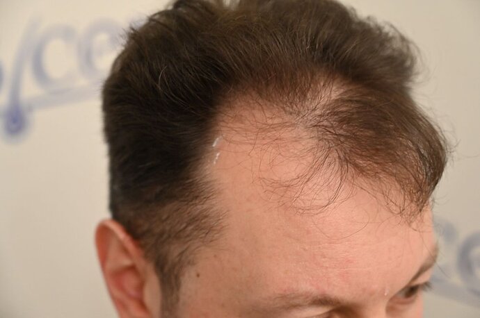 Ozlem Bicer MD-Hair Transplant-2910 Grafts FUE by micro-motor, 7. months result photo