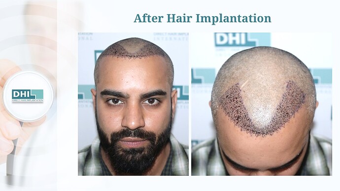 DHI India™ | NW 3 | 1,524 Grafts | Youthful Hairline Restored | DHI Hair Transplant photo
