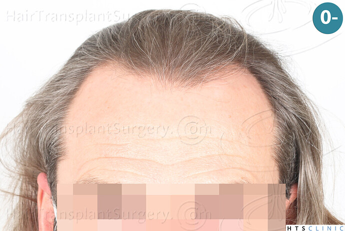 Dr Devroye + Dr Montesanti + Dr Jenard / 2005 FUE Partial shave / Hairline & temple corners photo