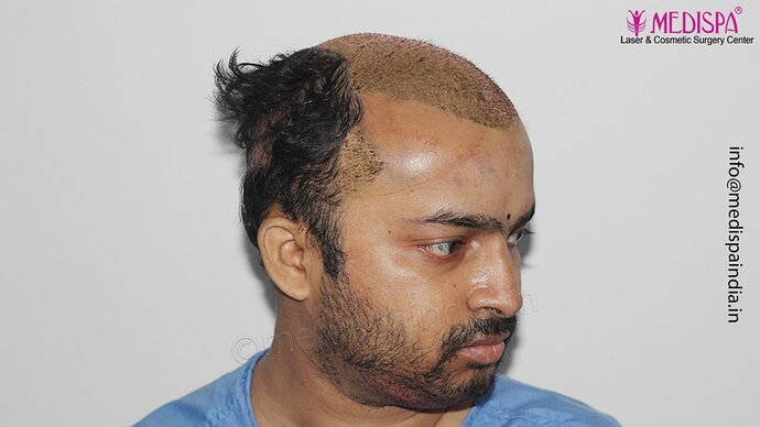 Dr. Suneet Soni - 5000 Grafts, Combine FUT + FUE + Beard Technique, NW-V photo