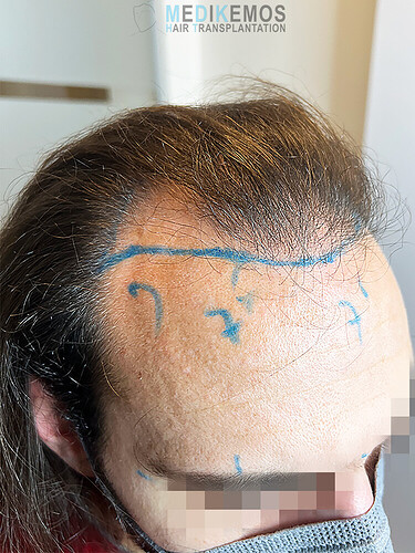 CASE DR. LUPANZULA - MEDIKEMOS CLINIC: 3017 UFS, FUE, FRONT, TEMPLES AND LOW MIDSCALP photo