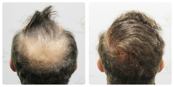 Dr Bonaros, Glasgow, UK / 3986 FUE grafts / 0-12 Months photo
