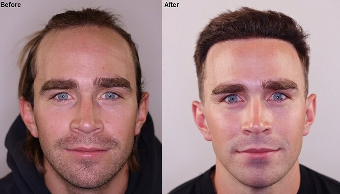 Dr. Barton Hair Transplant Result 2,500 grafts photo