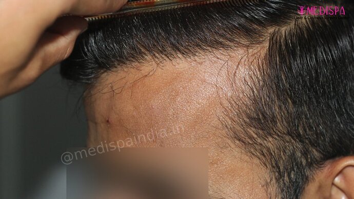 Dr. Suneet Soni - 4025 Grafts | 12-Month Result | Combination FUT + FUE photo