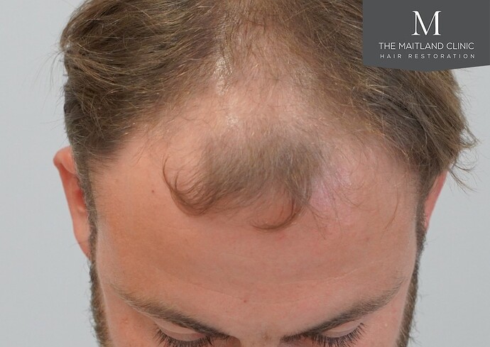 Dr Edward Ball-The Maitland Clinic. 1844 grafts by FUE photo