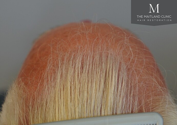 Dr Ball - The Maitland Clinic 2280 Grafts by FUE photo