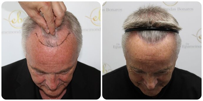 Dr Bonaros, Glasgow, UK / 3413 FUE grafts / 0-12 Months photo