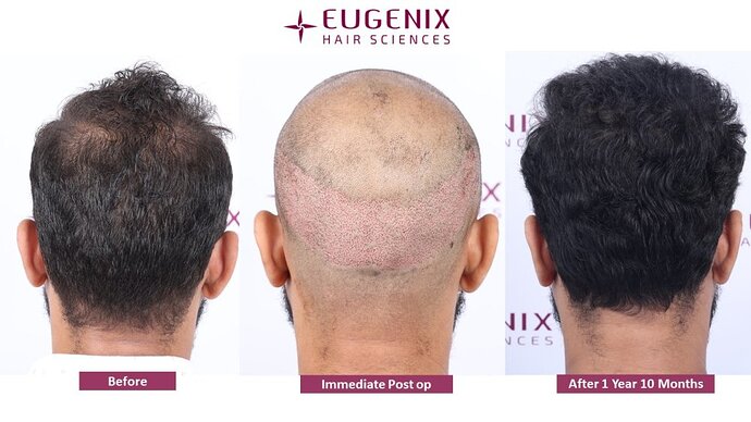 Eugenix Hair Sciences Clinic | Norwood Grade 3 | 22 Months Hair Transplant Results| photo