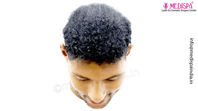 Dr. Suneet Soni - Afro Hair Transplant, 2 Sessions, 8355 Grafts, Combined FUT + FUE Technique, NW-VI, 5 Years Result photo