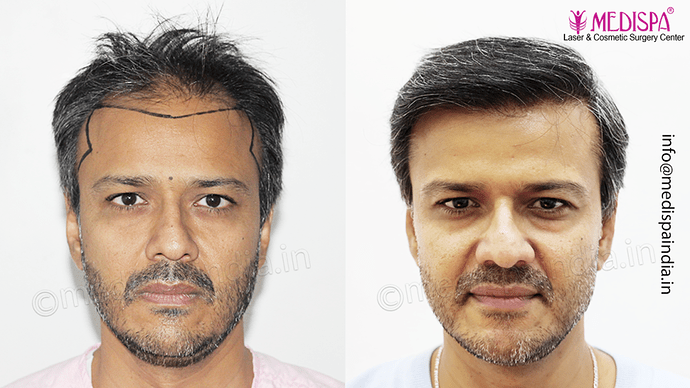 Dr. Suneet Soni - 4889 Grafts | 2.5 Years Result | Combination FUT + FUE + Beard photo