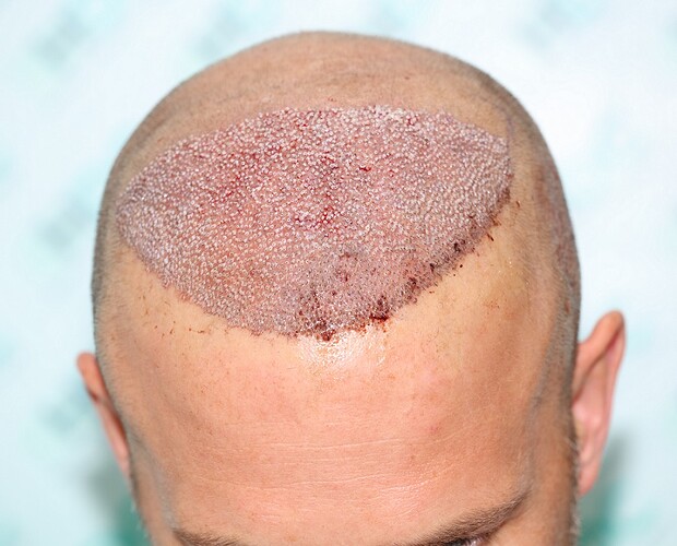 Hair Transplant Result - 10 months after – 5750 grafts in 2 FUE Sessions- Dr Christina – HDC Hair Clinic photo