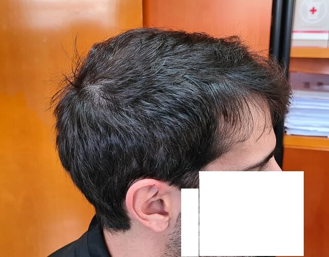 Result of 4000 grafts – 11 months after – NW class 4 photo