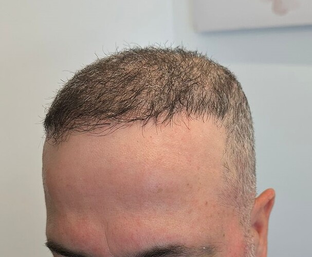 Major Repair of Mini Grafts - Result: 4160 Grafts – HDC Hair Clinic photo