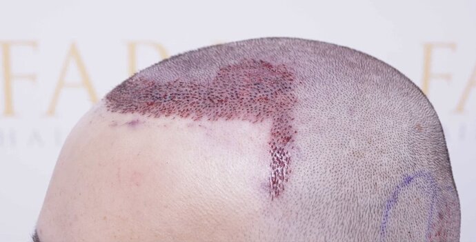 Dr Bessam Farjo FUE 1720 grafts to frontal recessions photo