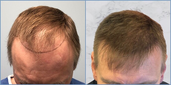 Dr. Nikos - hairline to mid-scalp restoration 2200 grafts grown out photo