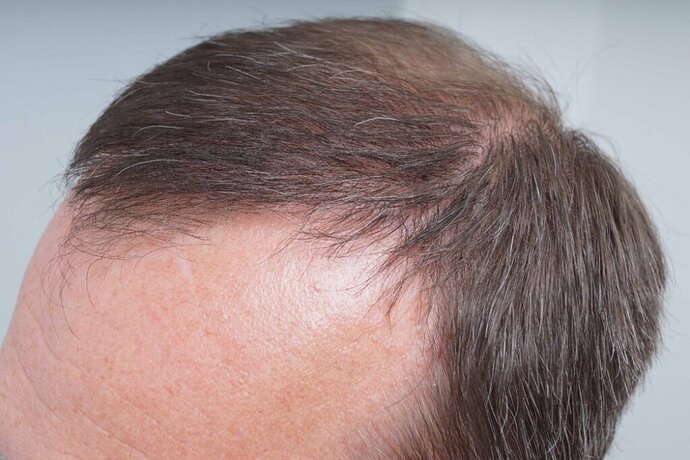 Dr B Farjo - FUE - 2091 Grafts photo