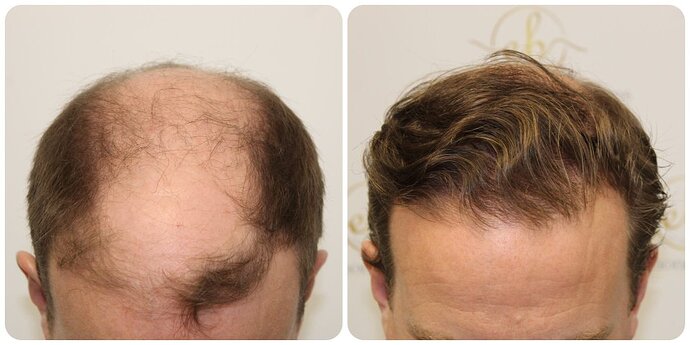 Dr Bonaros, Glasgow, UK / 4013 FUE grafts / 0-12 Months photo