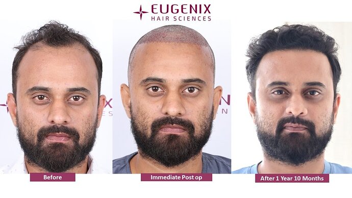 Eugenix Hair Sciences Clinic | Norwood Grade 3 | 22 Months Hair Transplant Results| photo