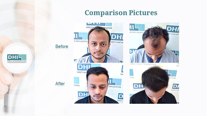DHI India™ | NW 4 | 4,265 Grafts | 6-Months DHI™ Hair Transplant Results photo