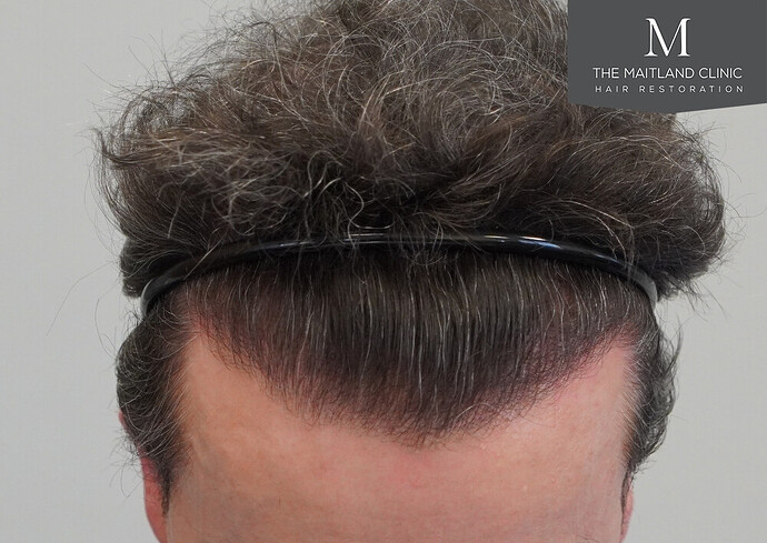 Before and after results: 1694 grafts by FUE at The Maitland Clinic (Dr Edward Maitland Ball) photo