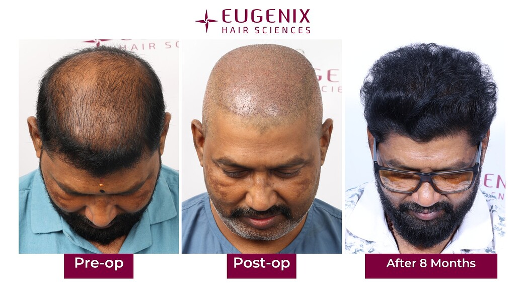 https://cdn.forumhairtransplant.com/optimized/3X/f/8/f859f61f042437c0845eefa5f6386ca35ed0f8b3_2_1035x582.jpeg