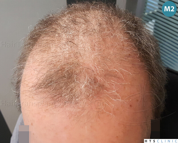 Dr Devroye + Dr Montesanti + Dr Jenard / 7015 grafts (4512 FUT + 2503 FUE) / 2 sessions photo