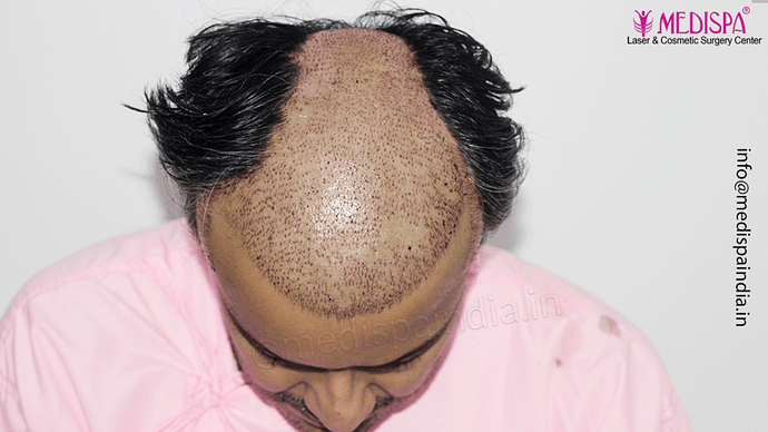 Dr. Suneet Soni - 4889 Grafts | 2.5 Years Result | Combination FUT + FUE + Beard photo