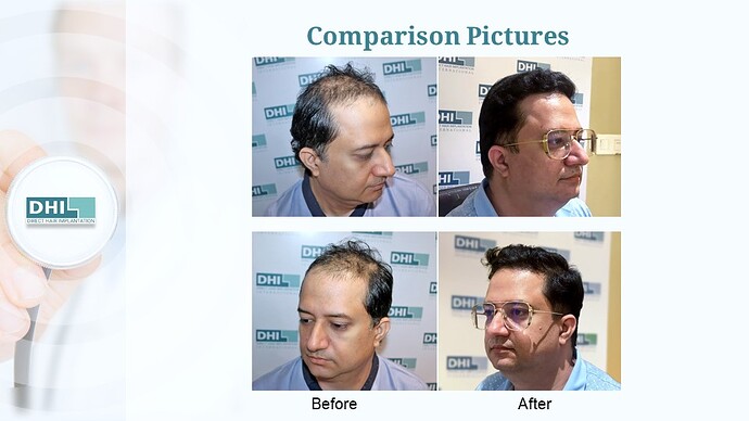 DHI India™ | NW 5 | 3,323 Grafts | 1 Year Hair Transplant Result photo