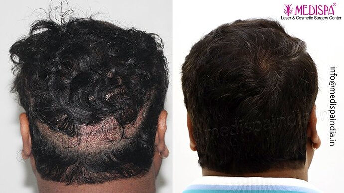 Dr. Suneet Soni - 4500 Grafts, 3 Year Result, NW-IV, Combine FUT + FUE Technique photo