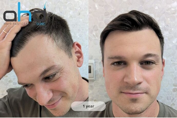 AHD Clinic / Technicians / 2250 grafts / FUE + DHI photo
