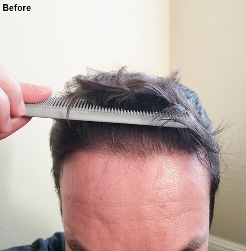 Dr. Ischayek hair restoration result - 1,075 grafts alviarmani photo