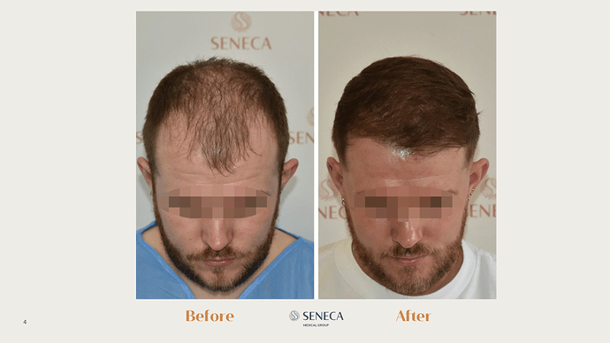 Seneca Medical Group - 2364 grafts with Direct FUE photo