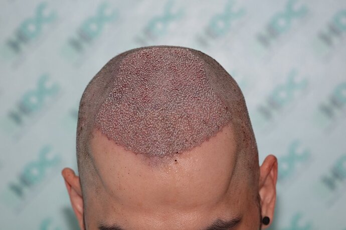 FUE Result for 4400 Grafts – 6 Months after – HDC Hair Clinic photo