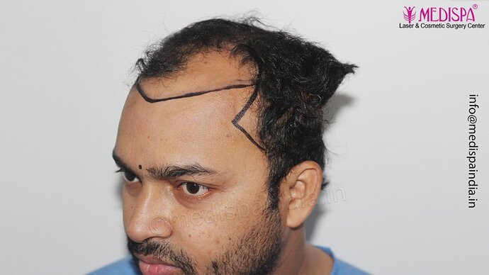 Dr. Suneet Soni - 5000 Grafts, Combine FUT + FUE + Beard Technique, NW-V photo