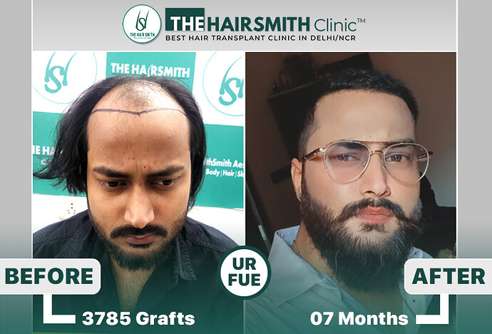 The HairSmith Clinic Delhi | NW Stage 6 | 3785 Grafts | 11 Months Hair Transplant Result photo