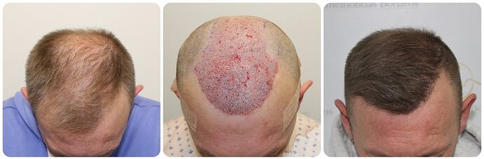 Dr Bonaros, Glasgow, UK / Receding Hairline Hair Transplant Result / 1814 FUE grafts / 0-12 Months photo