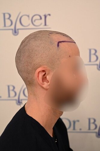 Ozlem Bicer MD-2340 Grafts FUE by micro-motor, 12. month result  photo