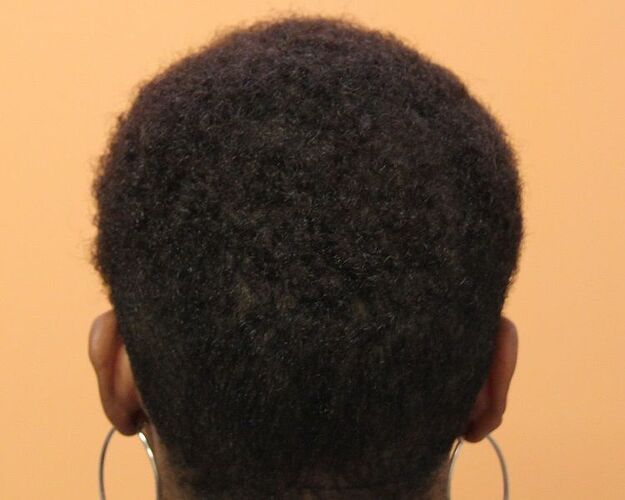 Dr. Bisanga, BHR Clinic, 2001 FUE / 0-8 Months. Female case photo